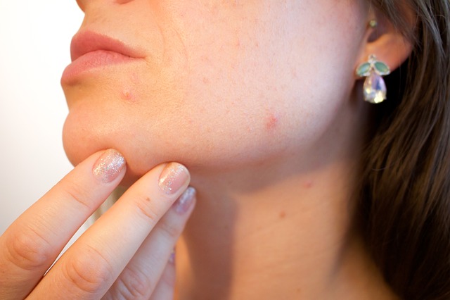 Soin du visage : les masques anti-acné