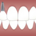 Que faut-il savoir sur la pose d’un implant dentaire ?