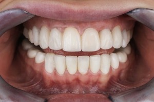 dents